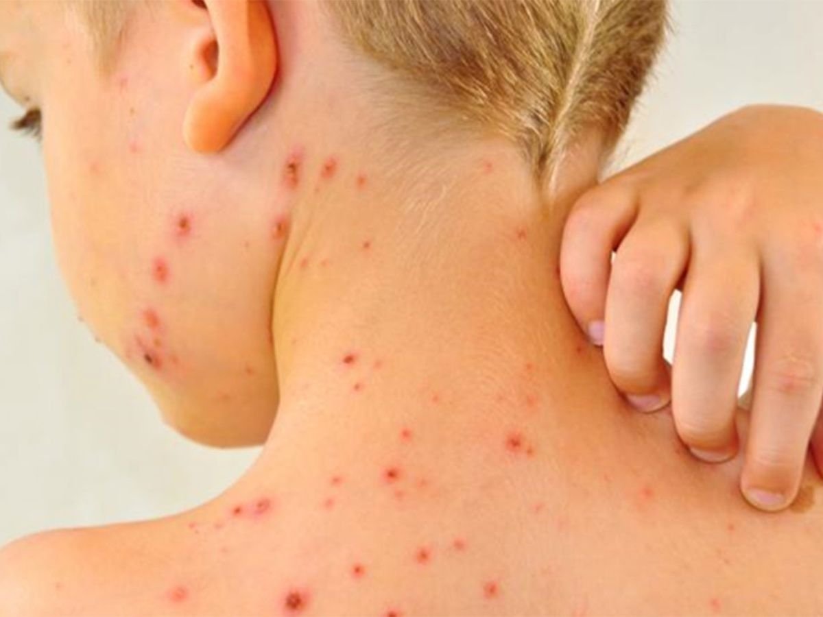 Tabasco acumula siete casos de sarampión