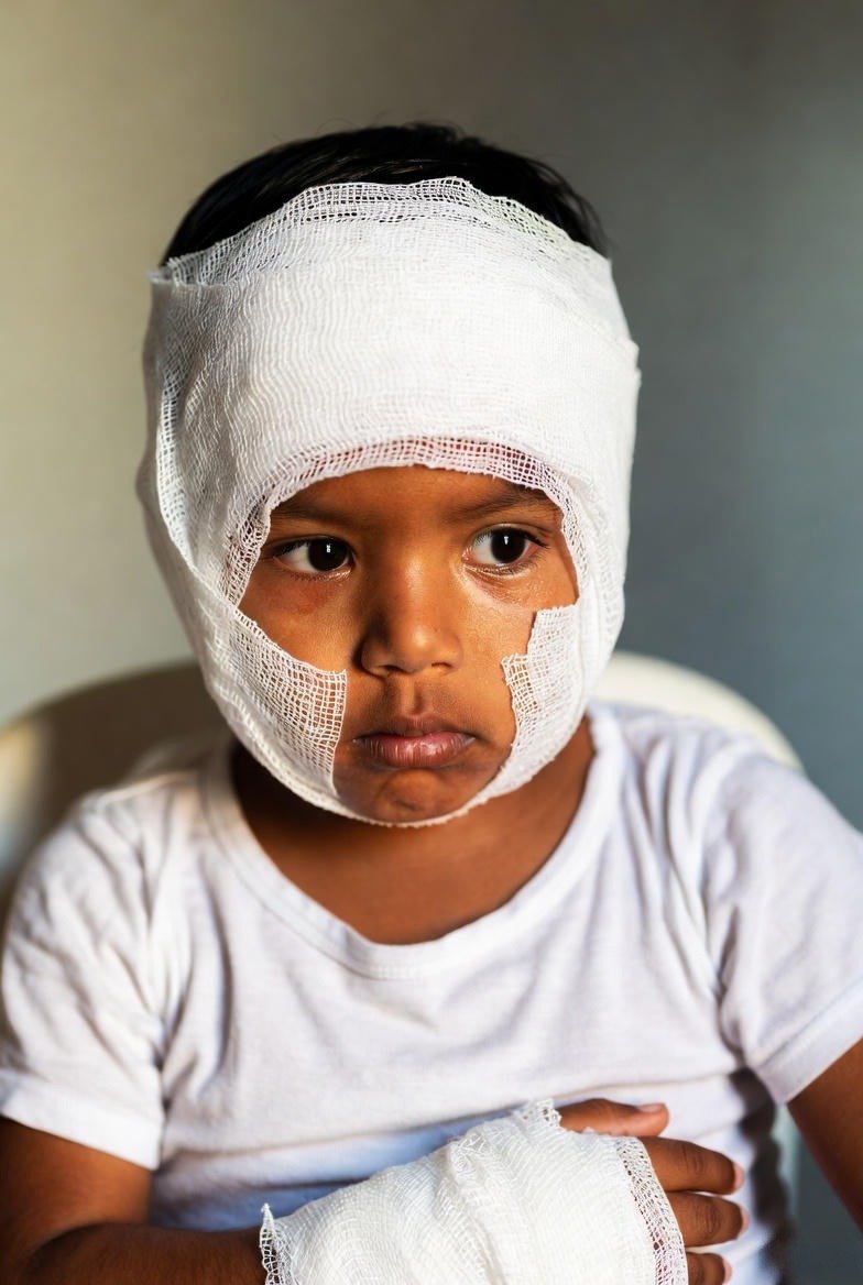 Uso de pirotecnia en menores puede ocasionar lesiones graves y discapacidad permanente: Salud