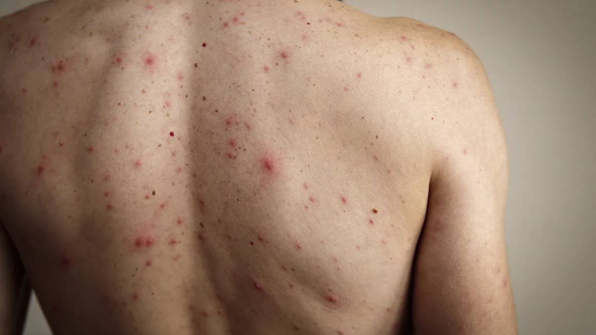 Reportan 6,374casos de sarampión y 24 defunciones al inicio de 2026