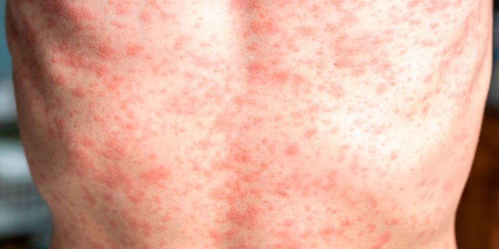 Confirman primera muerte por sarampión en Chiapas